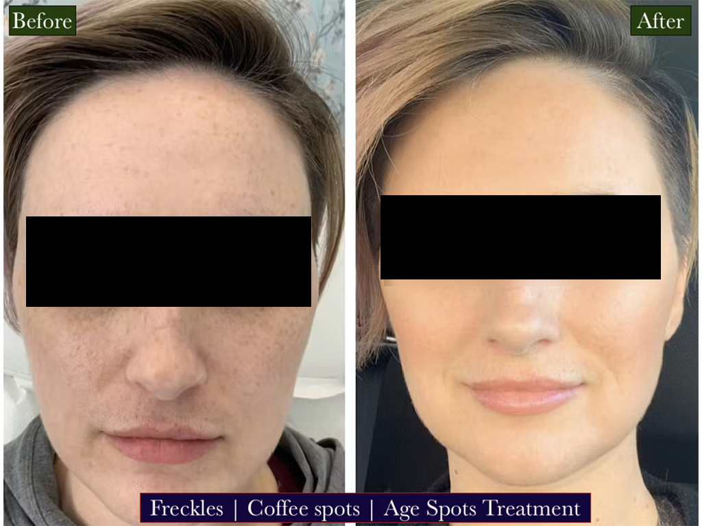Age Spot Treatment